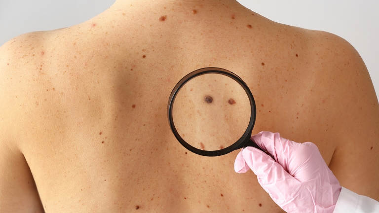 Hautkrebs rechtzeitig erkennen